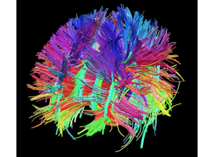 Whole-brain diffusion tractography: dense bundles of colour-coded streamlines